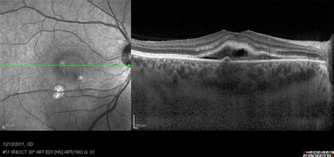 Recurrent Central Serous Choroidopathy Retina Image Bank