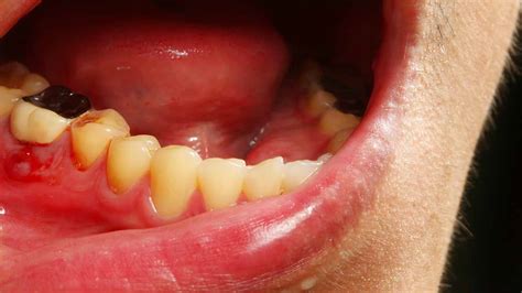 Gum Disease Periodontist Manhattan Ny Av Periodontics
