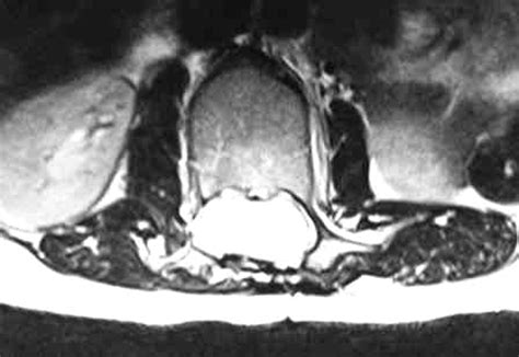 Recurrent Intramedullary Epidermoid Cyst Of Conus Medullaris Bmj Case