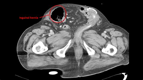 Figure 1 From Diagnosis Of Inguinal Region Hernias Wi