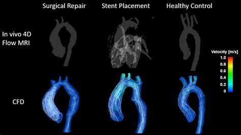 Computationally Enhanced D Flow Mri For The Assessment Of Pre And