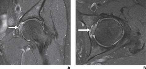 In humans the neck of the femur connects the shaft and head at a 125° angle, which is efficient for walking. Figure 1—45 from Diagnostic utility of MRI and MR ...