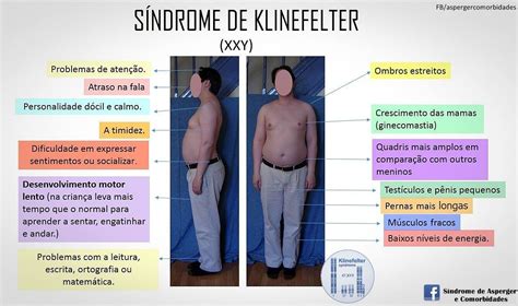 O Que é Síndrome De Klinefelter