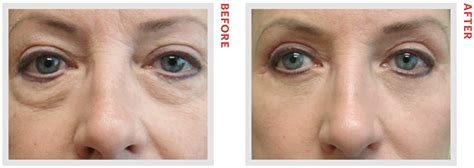 Eye Rejuvenation Procedures Newbeauty