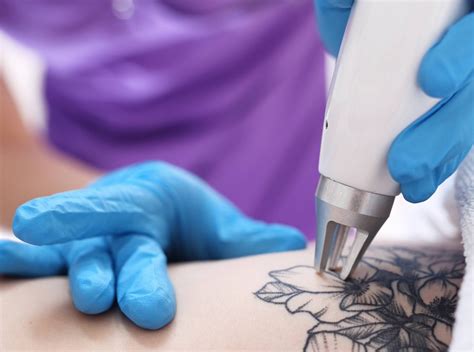 Tattoo Removal Liberty Laser Clinic