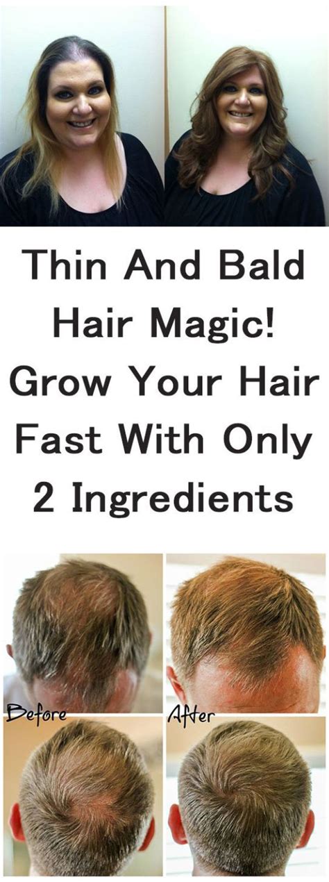 How To Make Hair Grow On Bald Spot Naturally Best Simple Hairstyles