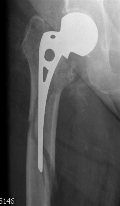 Periprosthetic Fractures Around Hip Hemiarthroplasty Performed For Hip
