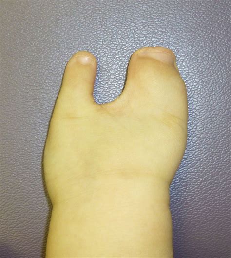 Central Deficiency With 2 3 Fingers Congenital Hand And Arm