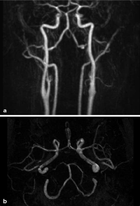 A MRI Time Of Flight TOF Angiogram Showing Thin Calibered