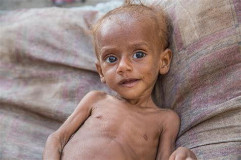 Yemen Could Plunge Into Further Famine If Hodeidah Is Cut Off
