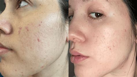 Affordable Chemical Peels For Acne Scars Before And After 2021