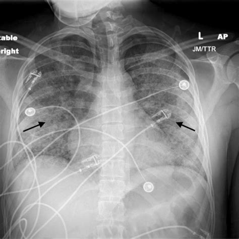 Chest X Ray Demonstrating Diffuse Central Predominant Interstitial