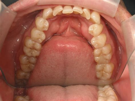 Crowded And Crooked Teeth Even After Braces Stovall And Cheng Dds Pllc