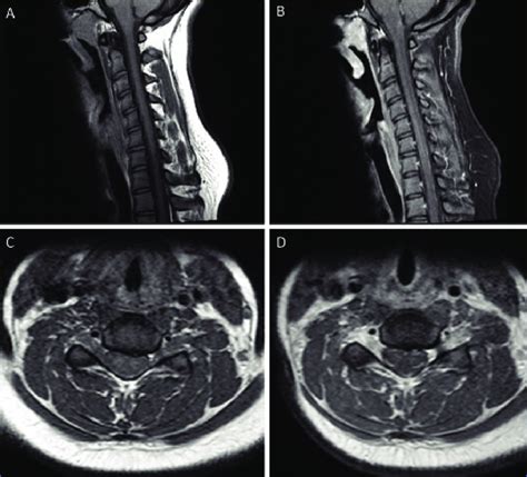 Magnetic Resonance Imaging Of The Cervical Spine Sagittal Section Shows