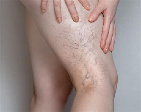 Spider Veins How Theyre Caused And How To Treat Them Bass Vein Center