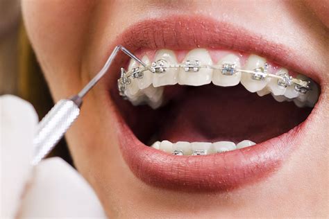 Orthodontie Mysmile Cabinet Dentaire Carouge Genève