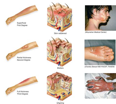 First degree burns are less severe than second degree burns and typically do not require medical treatment. Burns are classified according to the depth of tissue ...
