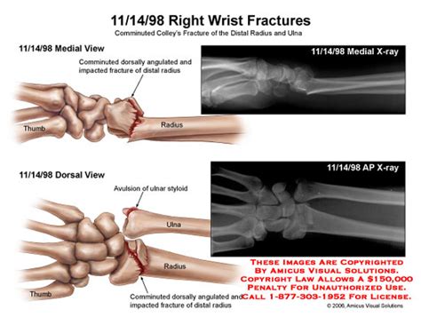 AMICUS Illustration of amicus,injury,radiology,comminuted ...