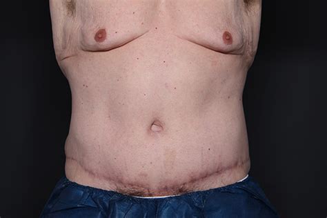 Abdominoplasty Before And After Larson Plastic Surgery
