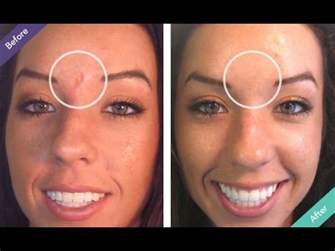 This face mask effectively lightens the acne scars and treats blemishes as well. How to cover scars instantly with Dermaflage - YouTube