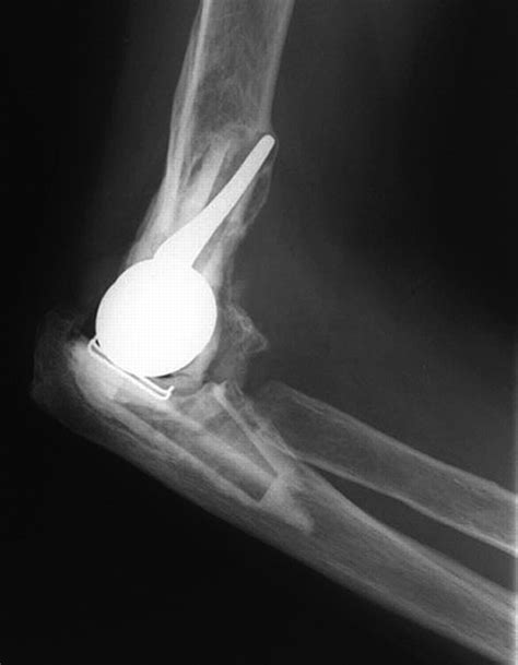 Souter Strathclyde Total Elbow Arthroplasty In Rheumatoid Arthritis