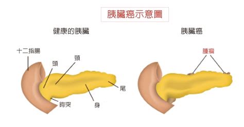 Aug 27, 2018 · 名嘴「許願折壽」給腦癌尪 2個月後胸部發現硬塊、焚垃圾毒氣致癌 美軍駐阿富汗20年.病死比戰死多、12歲就發願要當總統 拜登窮盡一生終登大位 小毛病 可能是胰臟癌前兆 | 台灣大紀元