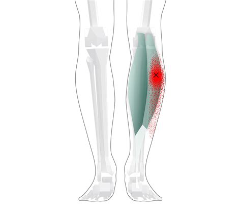 Gastrocnemius Trigger Points Overview Self Treatment Tips