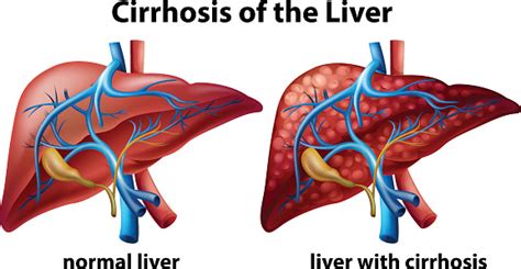 It is a common clinical finding, with various extraperitoneal and peritoneal causes (box 1), but it most often results from liver cirrhosis. Enlarged spleen (splenomegaly) causes, symptoms, spleen ...