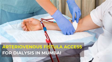Arteriovenous Fistula Access For Dialysis Mumbai India Dr Jathin S Vein Center