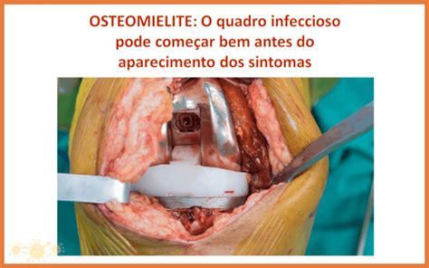 Osteomielite Saiba Mais Sobre Ela Dra Keilla Freitas Infectologista