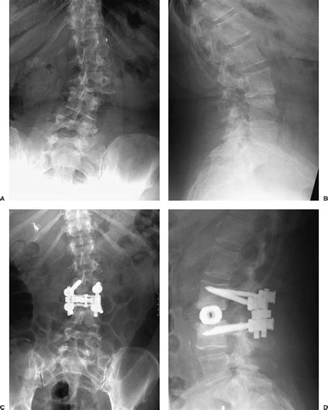 Endoscopic Lateral Transpsoas Lumbar Spine Fusion Neupsy Key