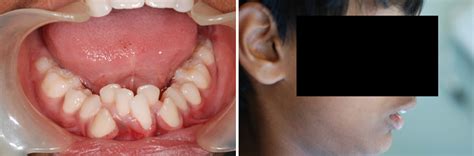 Case Study Mouth Breathing Causes Jaw Deformity Caring 4 Smiles