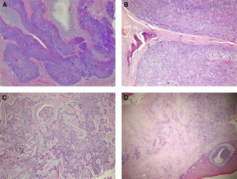 Myoepithelial Carcinoma Of Intraoral Minor Salivary Glands A