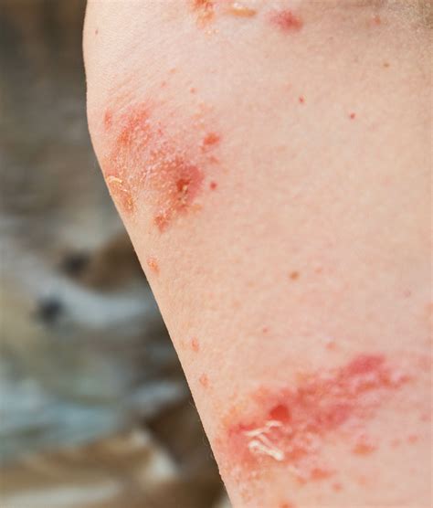 Poison Ivy And Poison Oak Treatments Bewell Immediate Care