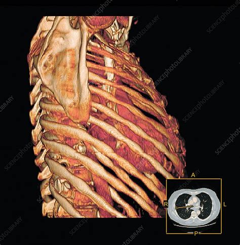 Ribcage And Heart 3d Ct Scan Stock Image C0104624 Science Photo