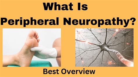 What Is Peripheral Neuropathy Best Overview Good Health Tube A
