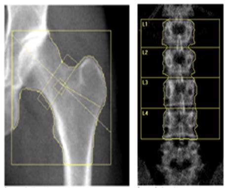 Hormone treatment restores bone density for young women with menopause
