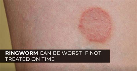 What Is Ringworm Here Is All That You Need To Know Marham