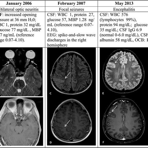 Pdf Overlapping Demyelinating Syndrome And Anti N Methyl D Aspartate