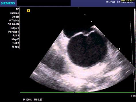 Pfo With Right To Left Shunt Using Agitated Saline Contrast Youtube