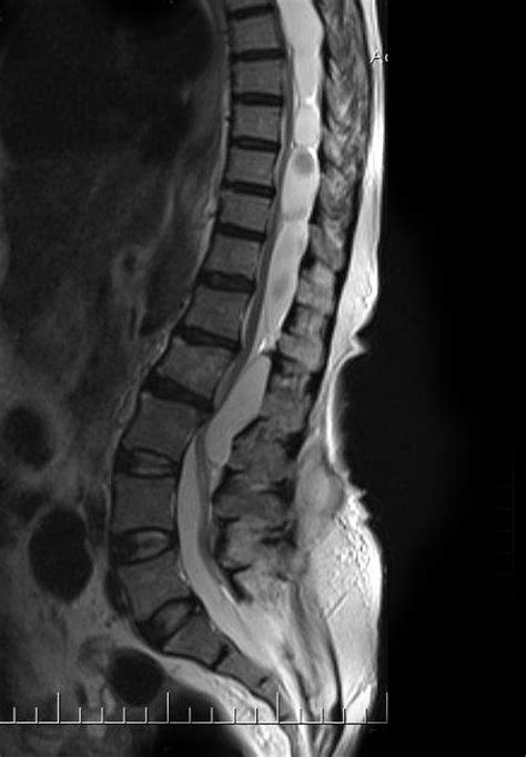 Multiple Spinal Arachnoid Cysts Image
