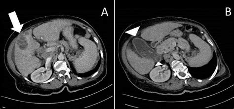 Axial Abdomino Pelvic Ct Images With Intravenous Contrast Figure 1a