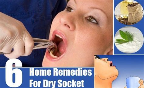 6 Best Home Remedies For Dry Socket Dry Socket Home Remedies Remedies