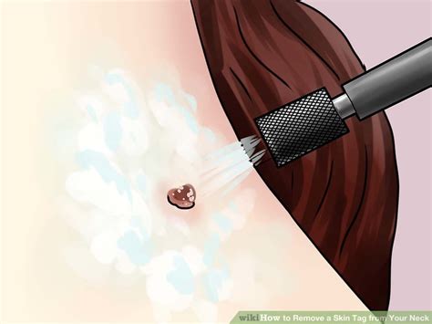 Unfortunately, in those circumstances, insurance companies do not cover mole removals and in fact that is true for any cosmetic procedure or surgery. The Best Ways to Remove a Skin Tag from Your Neck - wikiHow