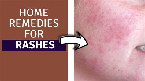 Home Remedies For Rashes How To Get Rid Of Rashes Fast Home Remedies For Rashes On Face