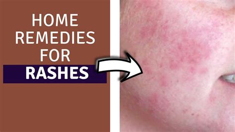 Learn how to treat and get rid of hives with hives naturally. home remedies for rashes - how to get rid of rashes fast ...
