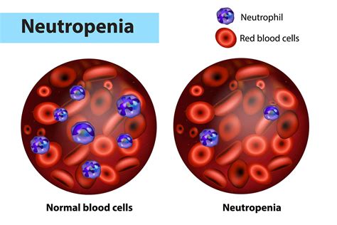 Neutropenia Causes Symptoms And Treatment