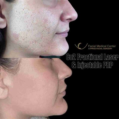 Co2 Fractional Laser Cyprus Facial Surgery