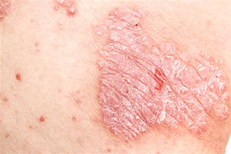 Pcsk9 May Be ‘implicated In Psoriasis Risk
