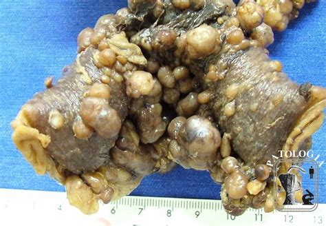 La péritonite est une infection grave qui peut déboucher sur la mort si elle n'est pas traitée, car la surface péritonéale est supérieure. Anatomia Patológica CASO NI-GI-00005 PERITONITE VISCERAL ...